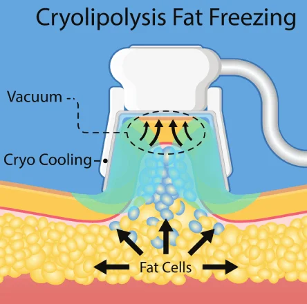 An infographic showing how fat freezing works