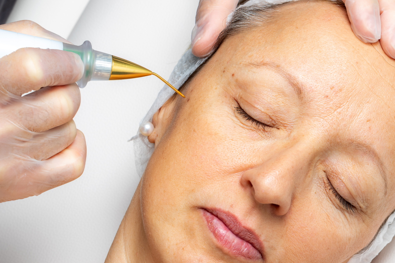 A woman receiving a plasma fibroblast treatment