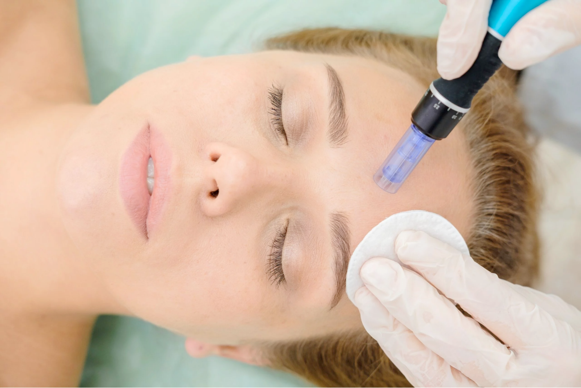 A woman getting a microneedling treatment