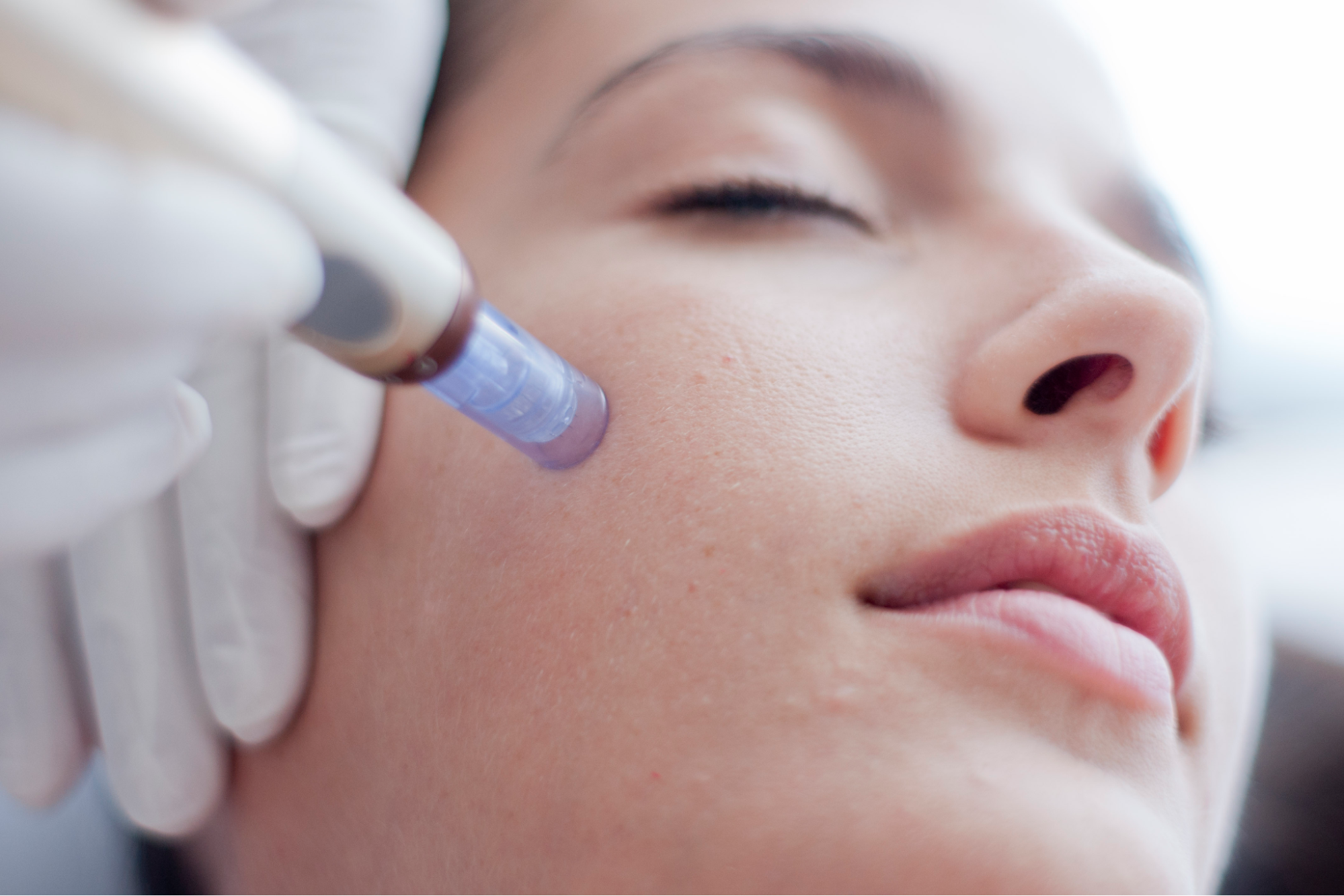 A woman having a microneedling treatment