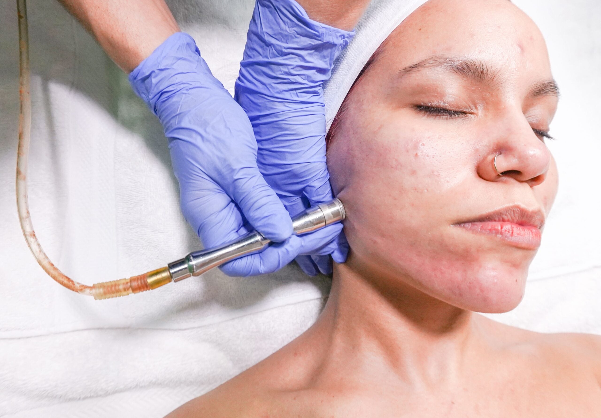 A woman getting a microdermabrasion treatment