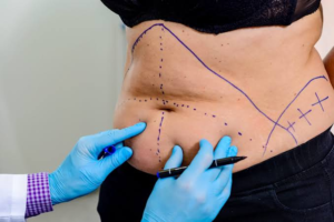 A women having her stomach assessed for a fat freezing treatment