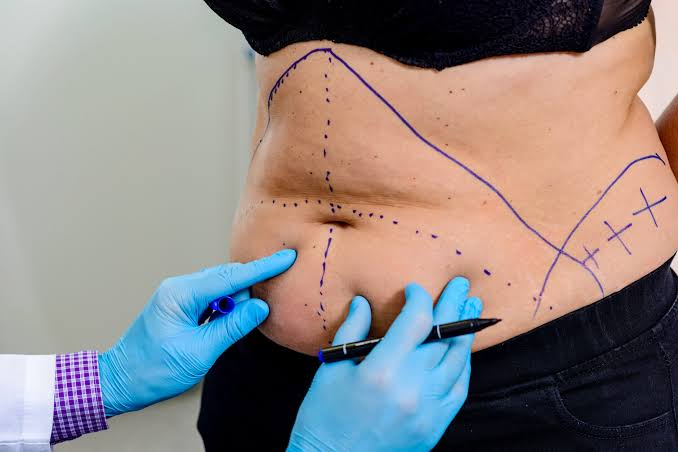 A women having her stomach assessed for a fat freezing treatment